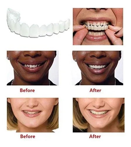 Smile Veneers